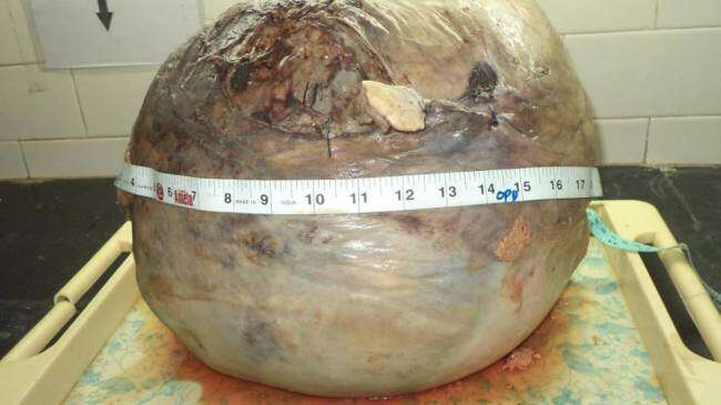 tumor gigante