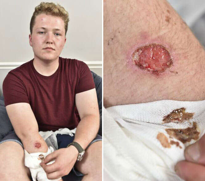 Adolescente adormece em cima de iPhone 5 e acorda com queimadura profunda