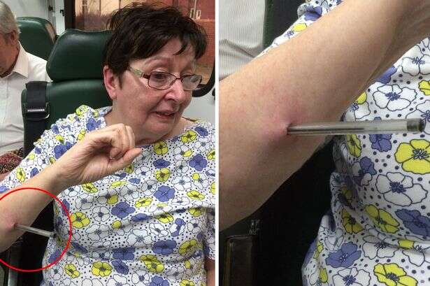 Caneta encravada em braço de mulher Caneta encravada em braço de mulher