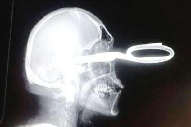 Homem chega calmamente em hospital enquanto carregava tesoura encravada na cabeça