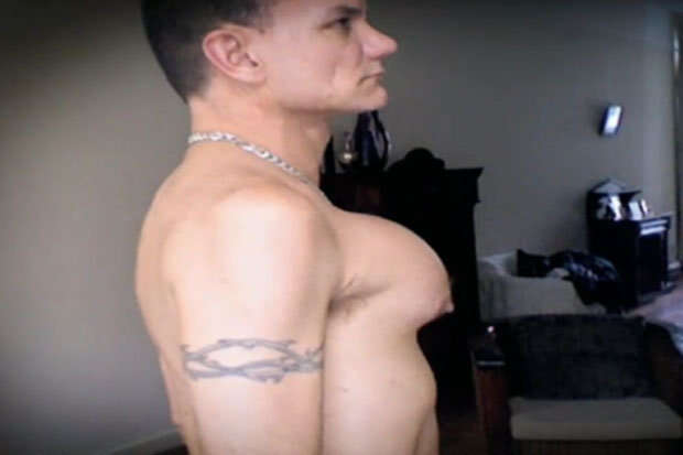 Homem implanta silicone no peito para ficar definido e acaba deformado Homem implanta silicone no peito para ficar definido e acaba deformado