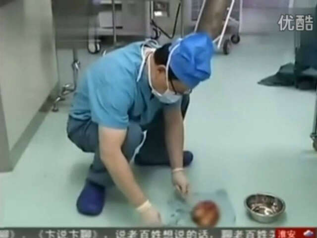 Bebê nasce grávido na China