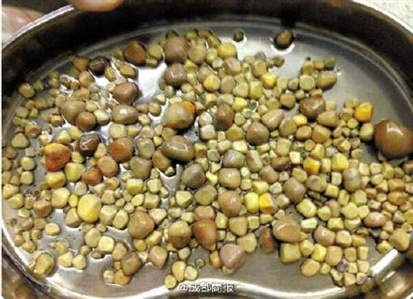 Homem tem 420 pedras retiradas de um de seus rins
