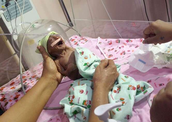 Pais abandonam bebê que nasceu com pele enrugada