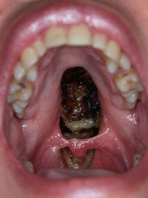 Dentista choca o mundo ao publicar perfurao no cu da boca de paciente causada pelo uso da cocana