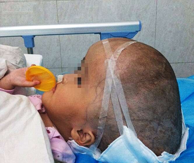 Toddler With Massive Head Saved By Ground Breaking Surger