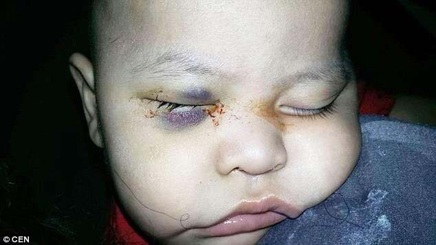 Bebê acabou cego ao ter olho bom retirado