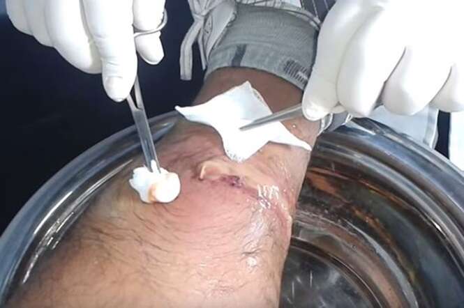 Vídeo nojento mostra momento em que paciente tem pus drenado de sua perna Vídeo nojento mostra momento em que paciente tem pus drenado de sua perna