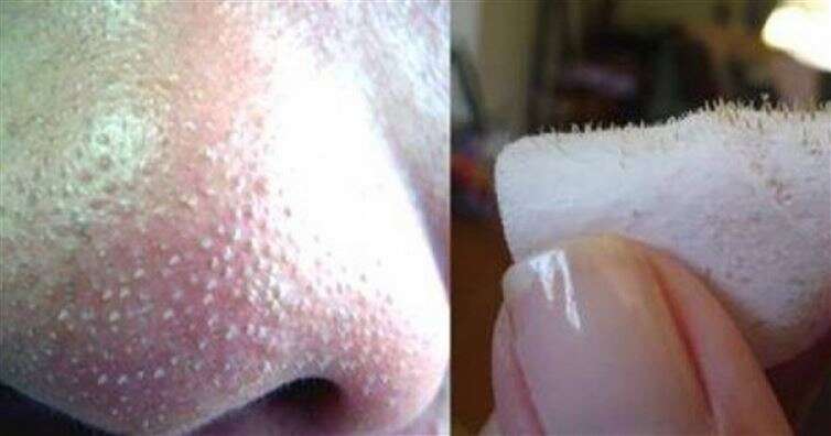 Aprenda como remover cravos do nariz usando água, sal e limão