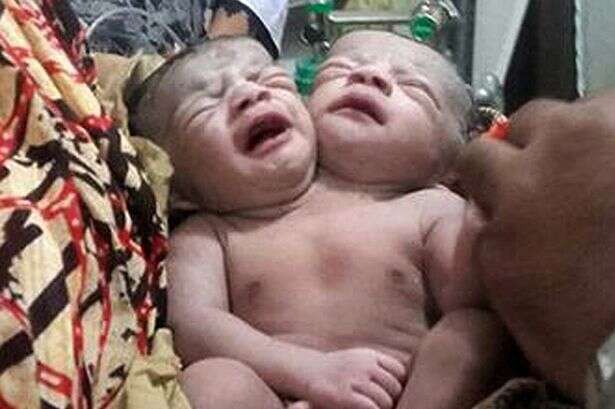 Bebê atrai multidão a hospital de Bangladesh após nascer com duas cabeças