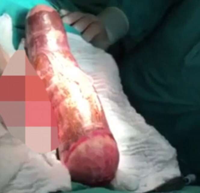 Homem é operado às pressas após ficar com mandioca de 45 cm preso no ânus