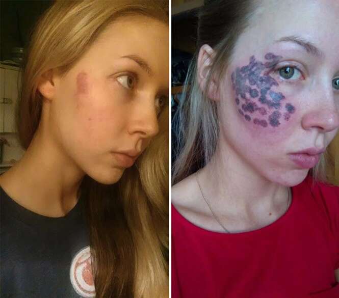 Blogueira fica com enormes queimaduras no rosto após tratamento a laser 