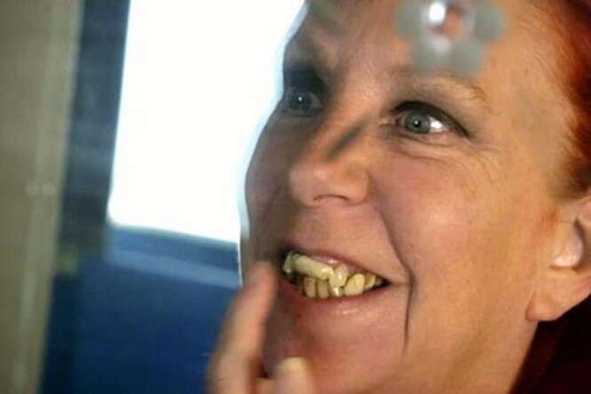 Mulher usa goma de mascar como falsos dentes 
