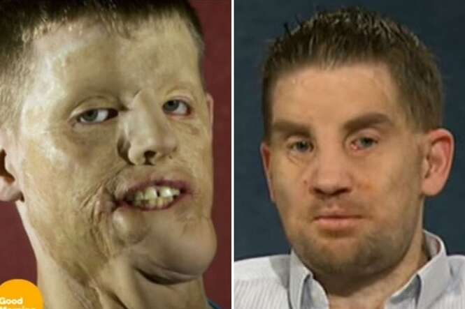 Homem que teve o rosto destruído em acidente passa por transplante facial
