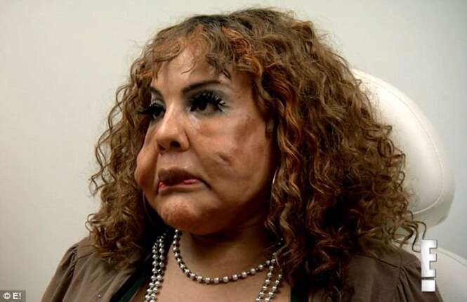 Transgênero que teve cimento injetado no rosto implora ajuda a médicos 