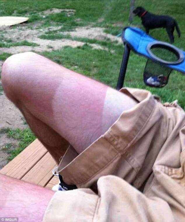 Homem com perna em três tons após tomar sol em dias diferentes viraliza na internet