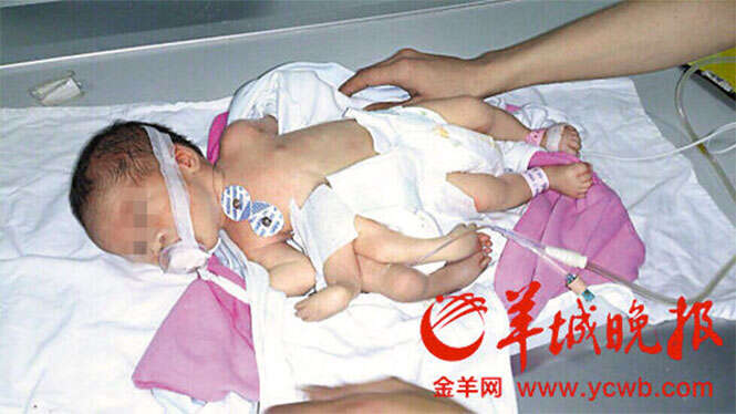 Bebê nasce com quatro membros extras na China