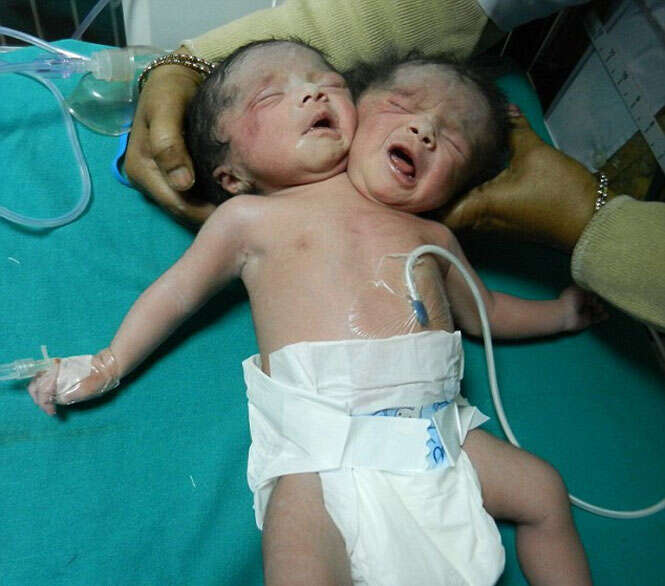 Bebê que nasceu com duas cabeças morre 20 dias depois
