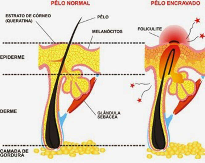 Pelo encravado