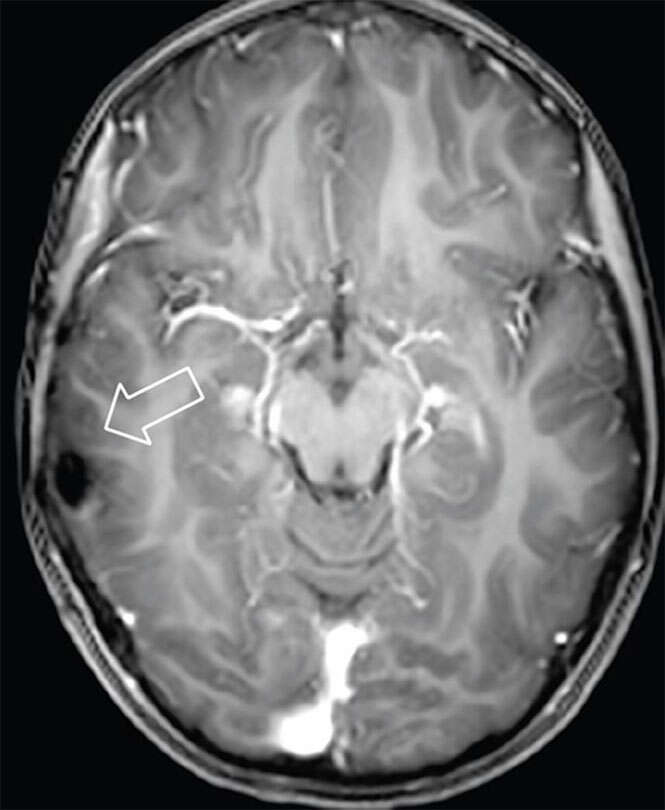 Tumor no cérebro