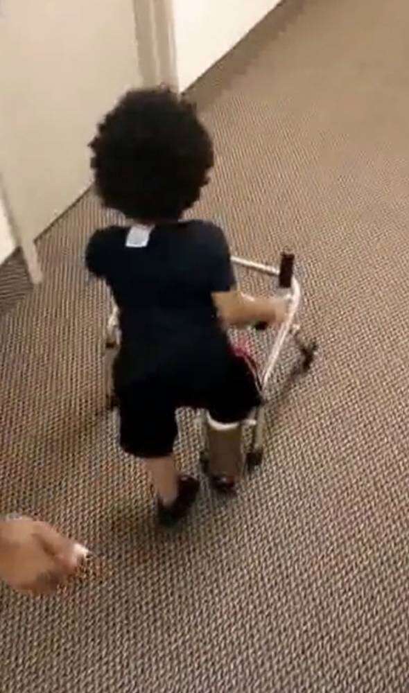 Criança de 2 anos com membro amputado por doença dando os primeiros passos