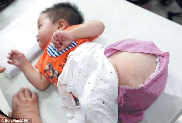 Bebê com tumor nas costas