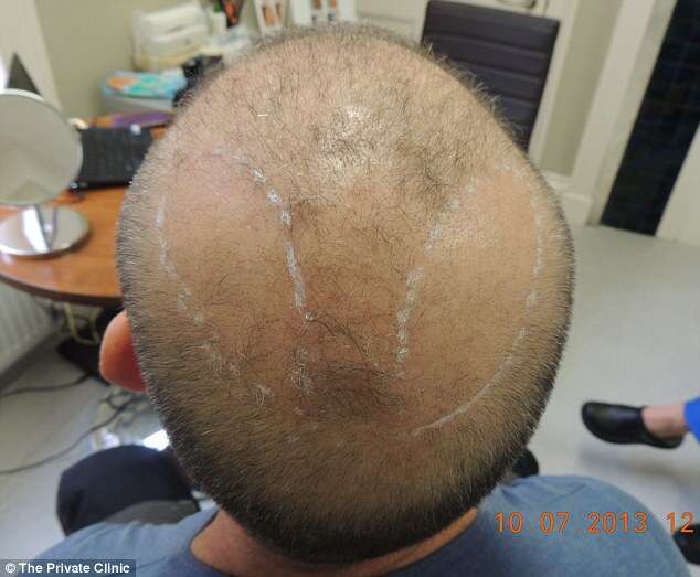 Cirurgia permite que homens carecas consigam levar cabelos do peito para a cabeça