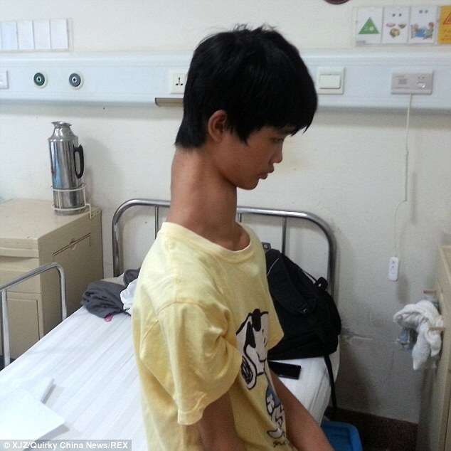 Adolescente com pescoço de girafa recebe doação para fazer cirurgia