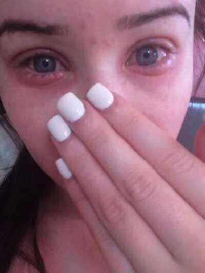 Adolescente fica com pálpebras dos olhos deformadas