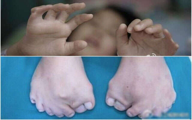 Criança com condição rara nasce com 15 dedos