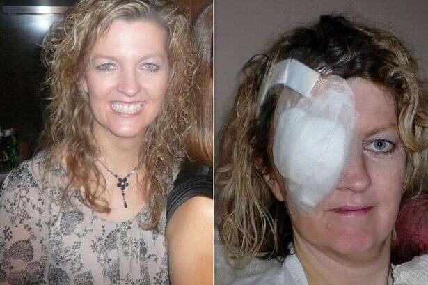 Mulher perde o olho por conta de câncer