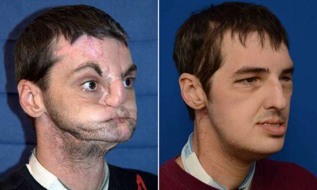 Depois de receber transplante completo de rosto, homem tenta reaprender a beijar