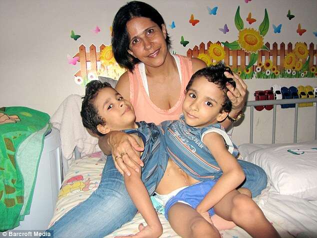 Gêmeos siameses brasileiros passarão por cirurgia de alto risco para se separarem