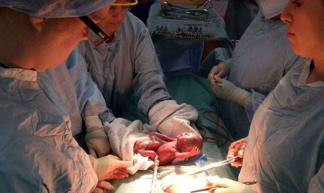 Mãe divulga imagem de bebê prematuro