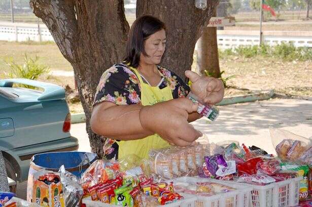 Mulher com doença rara e sem cura possui as maiores mãos do mundo