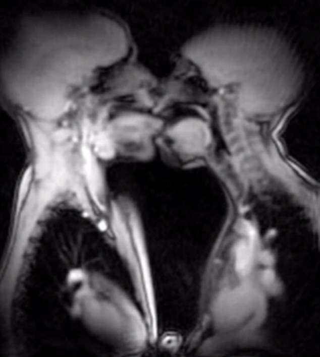 Vídeo gravado em scanner de ressonância magnética revela movimento do corpo durante beijos