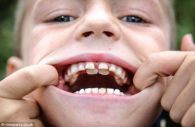 Criança possui duas fileiras de dentes em sua boca