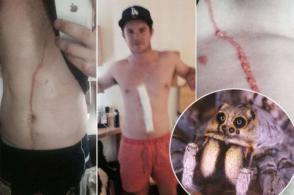 Jovem fica horrorizado ao descobrir aranha dentro de seu corpo após ela entrar por cicatriz de cirurgia