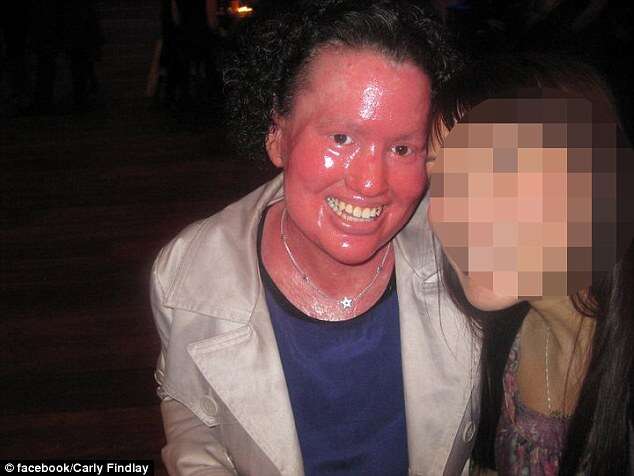 Mulher com doença rara de pele afirma que no Hallowee crianças temam sua aparência