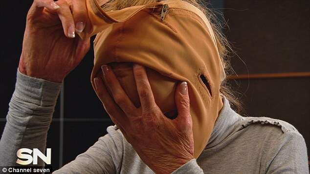 Mulher que passou mais de dois anos usando máscara após ter rosto incendiado, revela visual