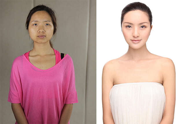 Mulheres antes e depois de cirurgias plásticas repercutem na internet