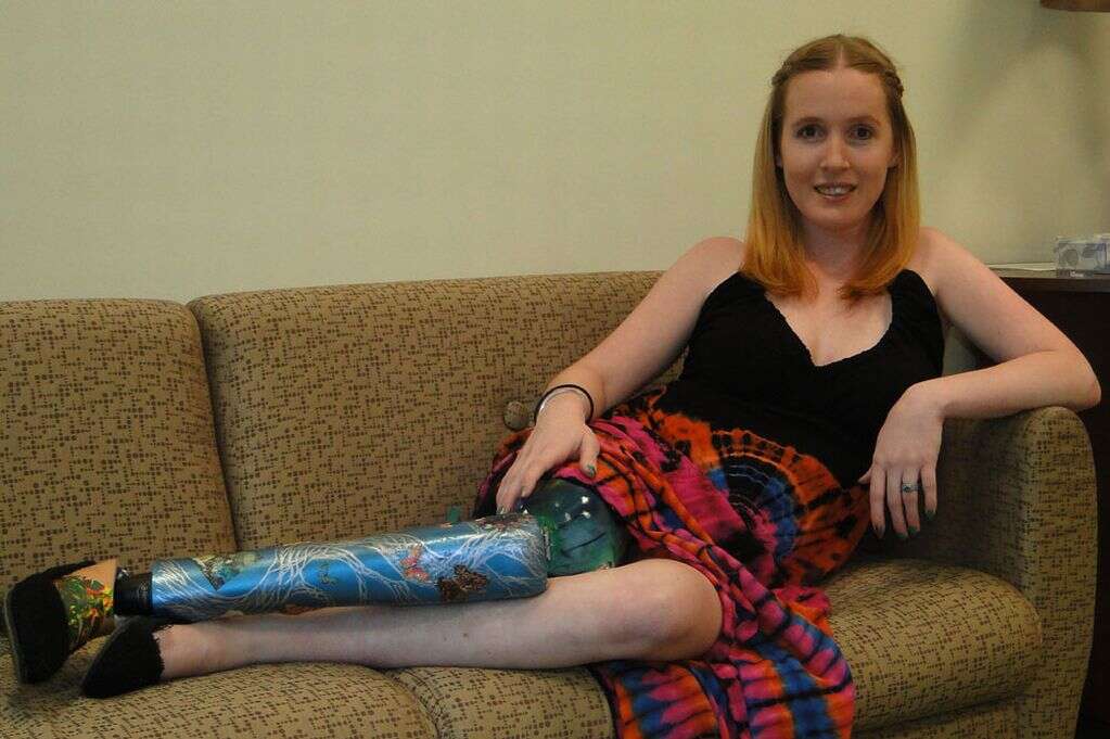 Mulher faz festa de despedida para perna dias antes de amputá-la