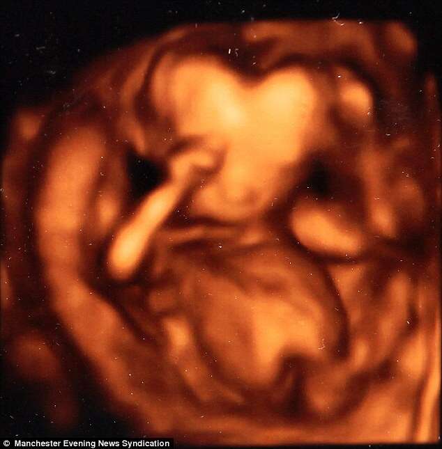 Exame de ultrassom mostra bebê com cabeça em formato de coração