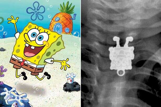 Médicos realizam exame de raio-X em criança e encontrarem Bob Esponja sorrindo