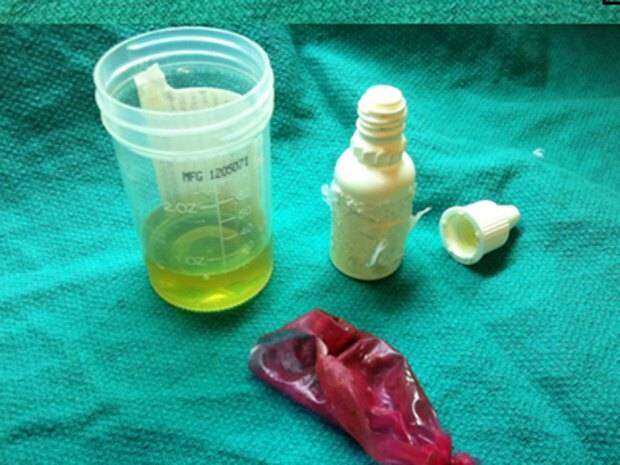 Médicos ficam surpresos ao removerem frasco de urina do reto de homem