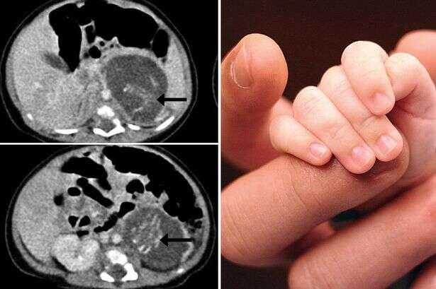 Bebê nasce grávido de gêmeos na China