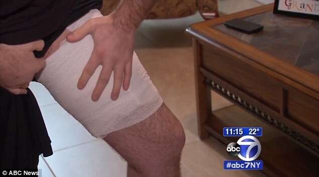 Homem fica com queimaduras graves na perna após iPhone explodir no bolso