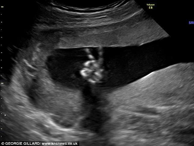 Imagem bomba na web ao mostrar bebê que faz sinal da paz no útero materno