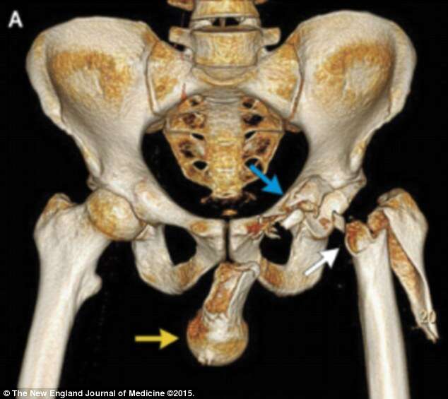 Homem tem escroto perfurado por osso da própria perna após acidente