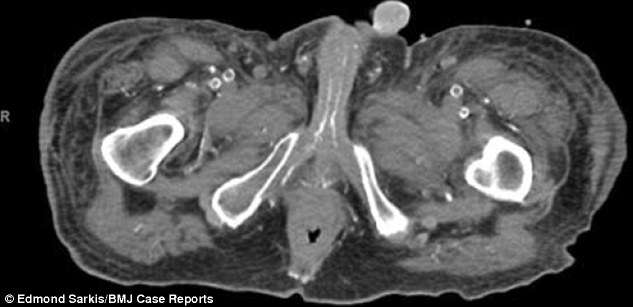 Homem tem cabeça de órgão genital removida após sofrer doença rara